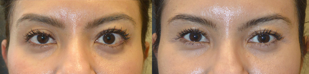 39 year old female, with graves thyroid eye disease with asymmetric eyes underwent following procedures: orbital decompression for bulging eyes (left worse), left upper retraction surgery, right upper eyelid ptosis surgery, and bilateral lower eyelid retraction surgery. Before and 3 months after eye plastic surgery photos are shown.