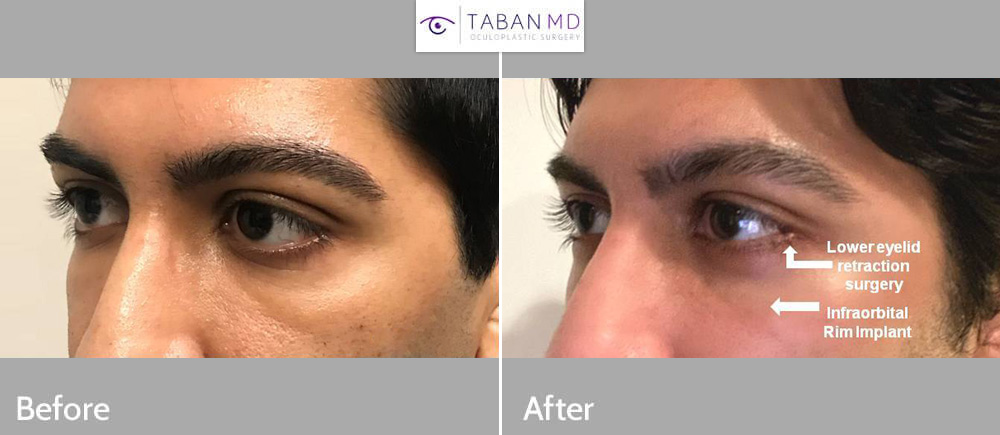 Young man with congenital lower eyelid retraction with sclera show and under eye hollowness underwent lower eyelid retraction surgery with canthoplasty (almond eye surgery) and infraorbital rim silicone implant.