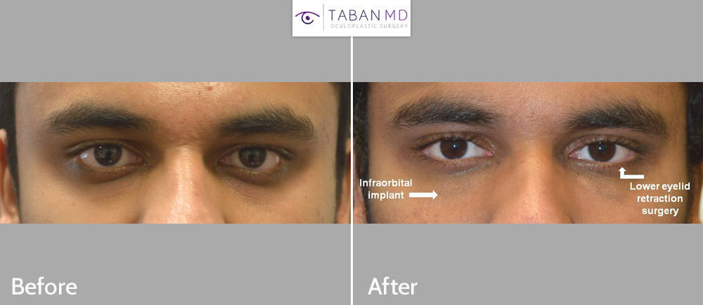 Young man, with sad tired eye appearance, underwent lower eyelid retraction surgery with canthoplasty (almond eye surgery) plus infraorbital rim silicone implant. Note improved eye shape with more almond eyes.