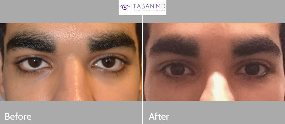 Young Middle Eastern man, with congenital lower eyelid retraction and midface bony deficiency, underwent lower eyelid retraction surgery with canthoplasty and infraorbital silicone implant to create more almond shaped eyes.