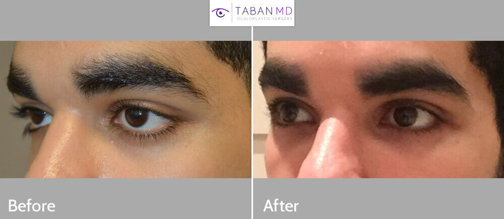 Young Middle Eastern man, with congenital lower eyelid retraction and midface bony deficiency, underwent lower eyelid retraction surgery with canthoplasty and infraorbital silicone implant to create more almond shaped eyes.