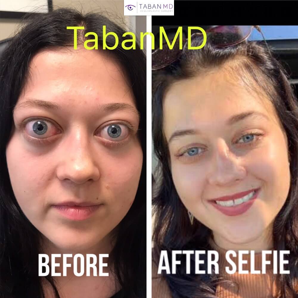 Young beautiful woman with severe Grave thyroid eye disease traveled from Slovakia to Los Angeles and underwent life-changing treatment including scarless orbital decompression surgery, lower eyelid retraction surgery, and upper blepharoplasty, to restore more natural eye shape and function. Before and 3 months after surgery results are shown.