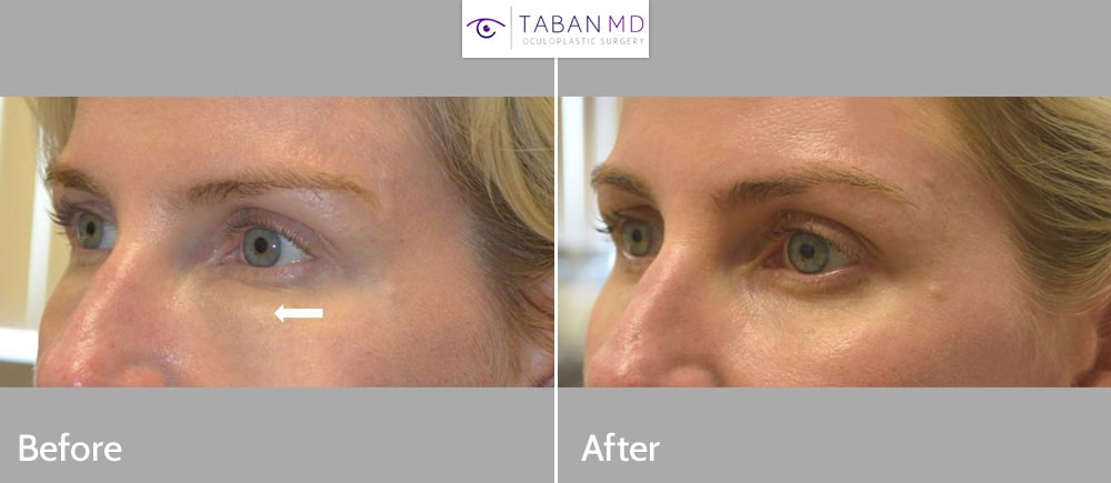 Hyaluronidase was injected to dissolve significant swelling and fullness and Tyndall effect of under eye filler (Juvederm) done by another injector.