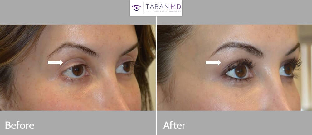 Young beautiful woman, with tired appearing eyes, underwent scarless internal droopy upper eyelid ptosis surgery and upper eyelid filler injection. Note more rested, youthful eye appearance in after photo.