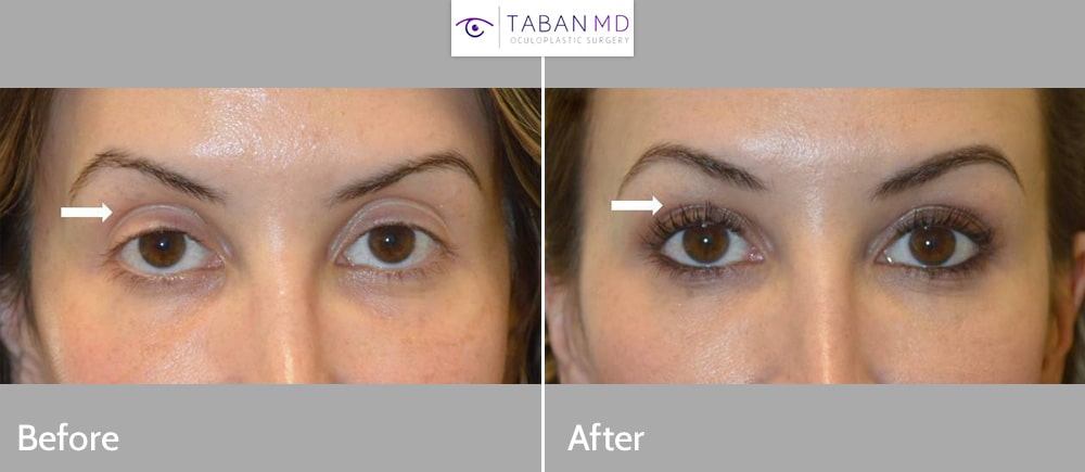 Young beautiful woman, with tired appearing eyes, underwent scarless internal droopy upper eyelid ptosis surgery and upper eyelid filler injection. Note more rested, youthful eye appearance in after photo.
