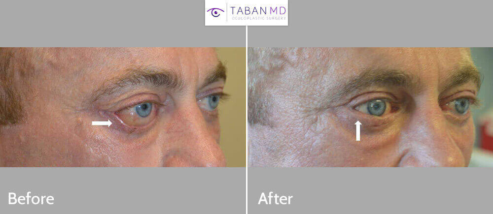 40+ year old man, with severe cicatricial lower eyelid retraction (due to previous botched lower blepharoplasty) underwent revision lower eyelid retraction repair with internal alloderm graft and external skin graft plus bulging eye orbital decompression surgery. Note the resolution of the eyeball swelling (chemosis)