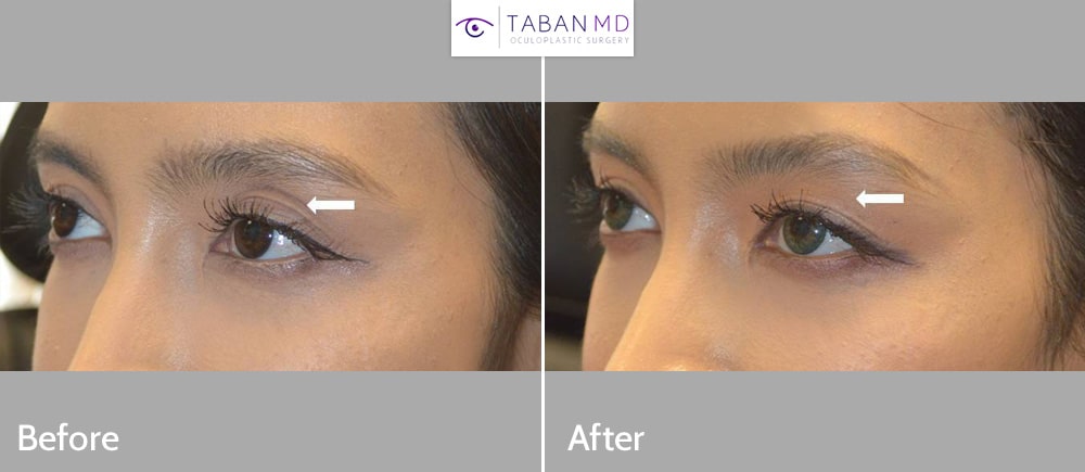 Young beautiful woman, with sunken left upper eyelid causing eye asymmetry, underwent left upper eyelid filler injection.