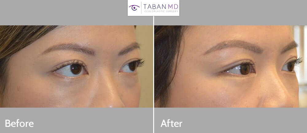 Young beautiful woman, with Graves thyroid eye disease bulging eyes, underwent scarless orbital decompression surgery and minimal invasive lower eyelid retraction surgery.
