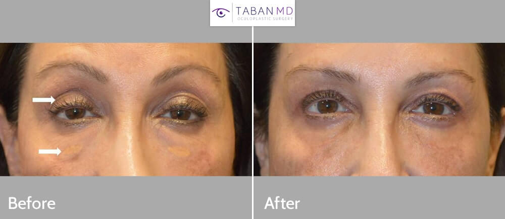 60+ year old woman, looking tired and older, underwent upper and lower blepharoplasty plus droopy upper eyelid ptosis surgery and eyelid xanthalasma (cholesterol deposit) removal. Note more rested youthful eye appearance.