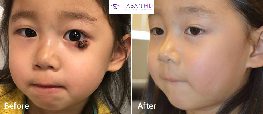 Before and 1 year after reconstructive lower eyelid surgery in a brave young girl with left lower eyelid necrotic lesion.