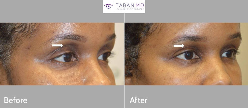 Upper eyelid filler injection to improve the sunken hollow upper eyelids in this African American woman.