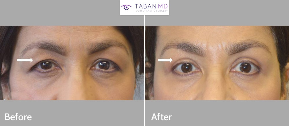 Woman with tired eye appearance due to saggy upper eyelids and brows, underwent upper blepharoplasty and pretrichial lateral brow lift.