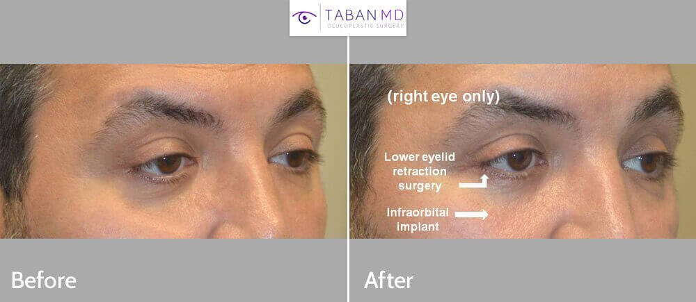 This man was bothered by lower eyelid and under eye asymmetry due to previous right eye trauma and fracture. He underwent right infraorbital rim silicone implant and lower eyelid retraction surgery. Note improved eye symmetry.