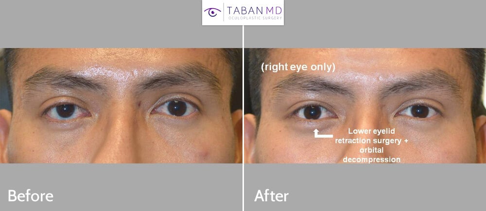 Young man, with genetic eye asymmetry with more bulging prominent right eye and lower eyelid retraction with sclera show, underwent right orbital decompression and right lower eyelid retraction surgery with canthoplasty