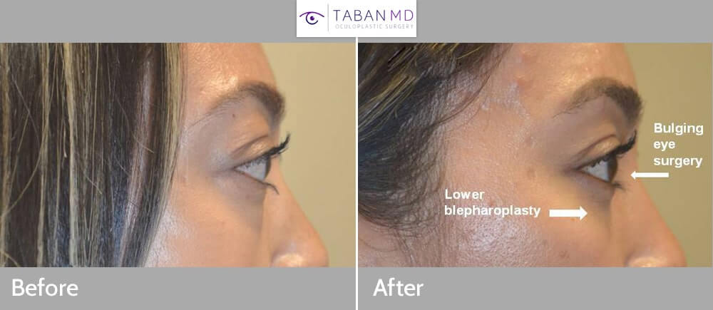 Orbital decompression page and gallery: Beautiful woman, affected by Graves thyroid eye disease causing bulging eyes and eye fat bags, underwent scarless orbital decompression and lower blepharoplasty. Note more natural and rested eye appearance in after photo 1 month after surgery.