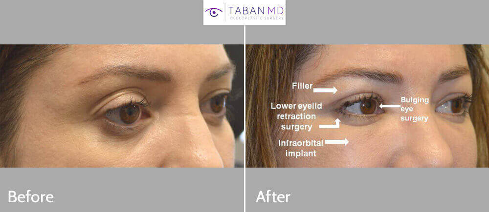 Woman who was unhappy about her eye shape and eye asymmetry, underwent eye plastic surgery including cosmetic bulging eye orbital decompression, infraorbital rim silicone implant, lower eyelid retraction surgery with canthoplasty, right upper blepharoplasty and left upper eyelid filler injection. Note more almond shaped and symmetric eye appearance in the after photo taken 1 month after almond eye surgery.