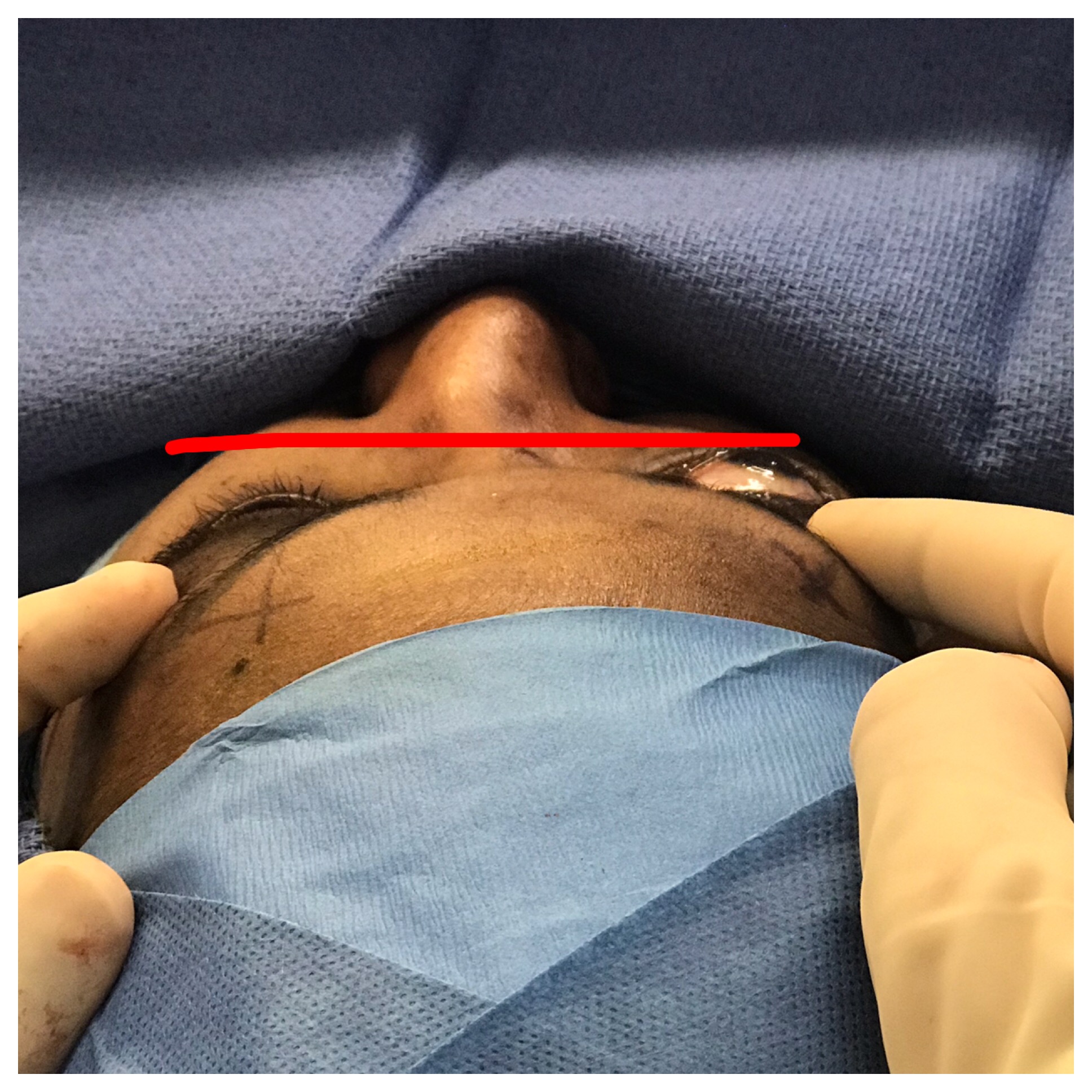 Intraoperative photo showing immediately after scarless left orbital decompression surgery, contrasted with yet untreated bulging right eye.