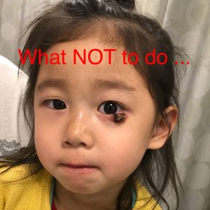 What NOT to do! Although most eyelid stye (chalazion) go away, there are some that are more aggressive and need to be drained. Parents of this 3 year old girl assumed the stye was going to resolve on its own but it progressively got larger with tissue destruction.