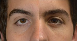 18-year-old male, with congenital lower eyelid retraction with negative canthal tilt and droopy upper eyelids (ptosis), underwent almond eye surgery including lower eyelid retraction surgery (with internal alloderm spacer graft), canthoplasty, and upper eyelid ptosis surgery. Before and 3 months after cosmetic eye transforming surgery photos are shown.