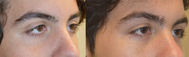 18 year old male, with congenital lower eyelid retraction with negative canthal tilt and droopy upper eyelids (ptosis) underwent almond eye surgery including lower eyelid retraction surgery (with internal alloderm spacer graft), canthoplasty, and upper eyelid ptosis surgery. Before and 3 months after cosmetic eye transforming surgery photos are shown.