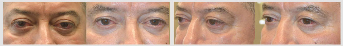 59 year old male, with bulging eyes due to Graves thyroid eye disease, underwent scarless orbital decompression surgery. Before and 3 months after surgery photos are shown.
