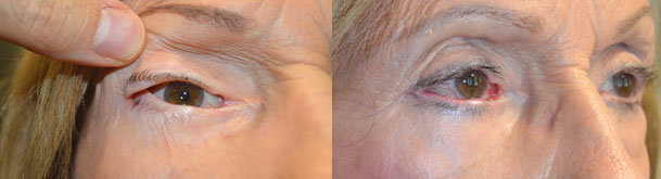 86 year old female, with significant eye irritation from previous canthoplasty, underwent revision right canthoplasty. Before and 3 months after surgery photos are shown.