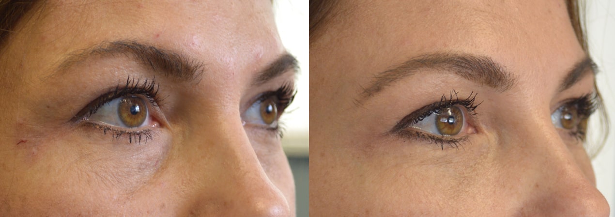636 year old female, with significant under eye tear trough deformity causing hollowness and dark circles, underwent tear trough eyelid Restylane filler injection. Before and 1 month after photos are shown.