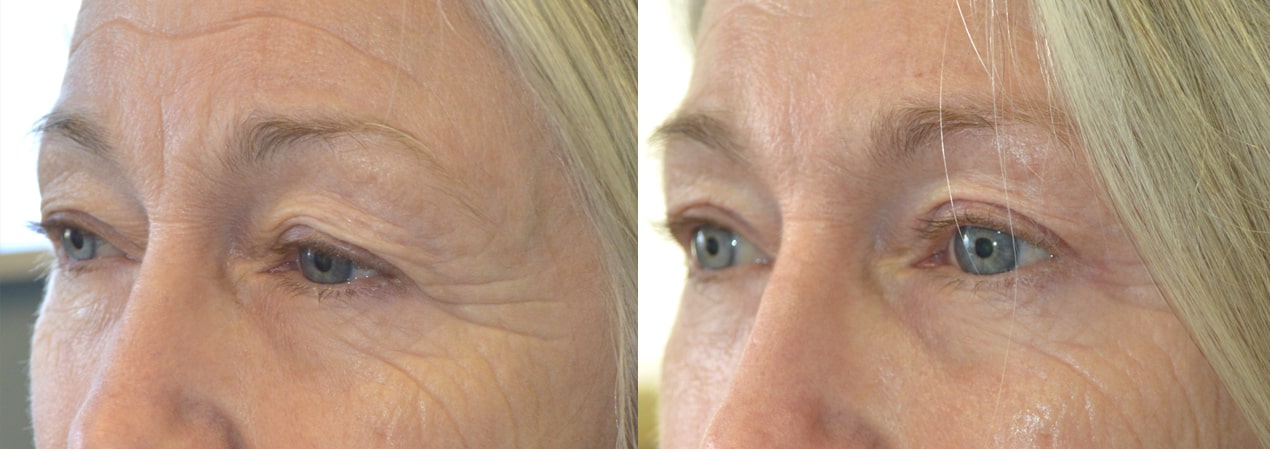 68 year old female, with saggy upper eyelids and brows, underwent cosmetic upper blepharoplasty and lateral pretrichial brow lift. Before and 3 months after eyelid surgery photos are shown. Note her forehead wrinkles improved too since she doesn’t need to lift her forehead as much.