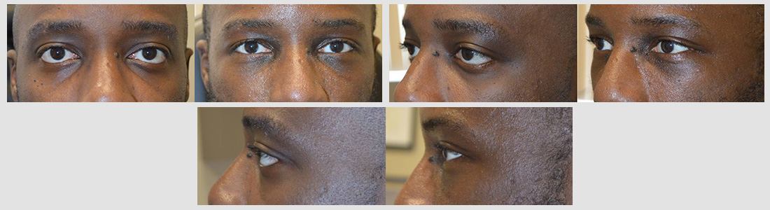 Young man, with genetic protruding eyes and sad tired eye appearance underwent cosmetic orbital decompression (bulging eye surgery), lower eyelid retraction surgery with canthoplasty (almond eye surgery) and infraorbital rim silicone implant. Note improved eye appearance.