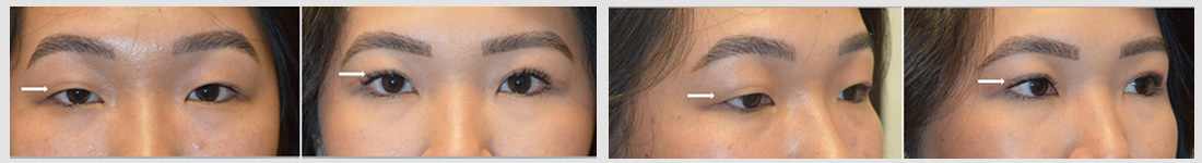 Beautiful young Asian lady, with single mongoloid eyelid, underwent Asian upper blepharoplasty (double eyelid surgery), to create more visible eyelid crease and open eyes.