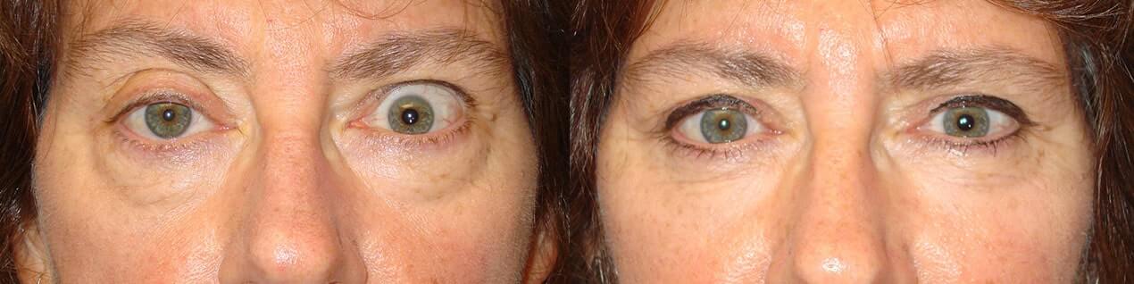 Before obvious eye asymmetry due to left upper eyelid retraction and right upper eyelid ptosis. After left upper eyelid retraction surgery and right upper eyelid ptosis surgery with improved symmetry.