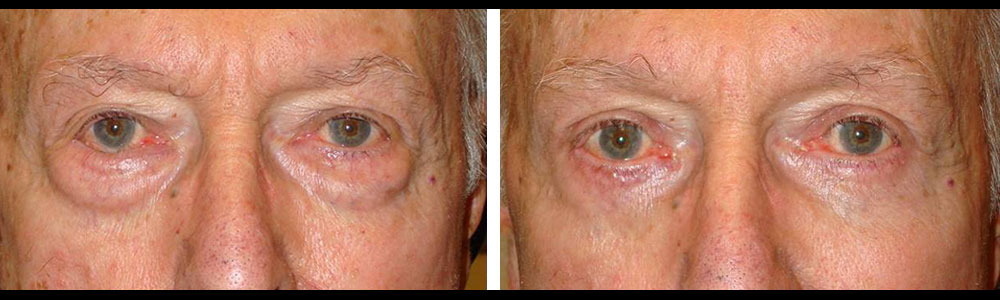 Before (left) and 2 months after (right) transconjunctival lower blepharoplasty with fat removal using hidden inside eyelid incision that did not require stitches.