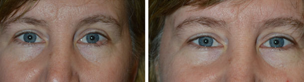 Before and one week after removal of large left lower eyelid lesion at the lash line.