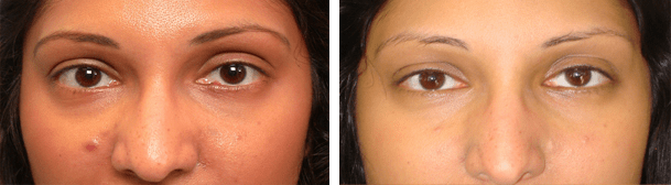 Before (left) and 1 month after (right) LEFT lower eyelid chalazion (stye) excision