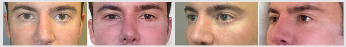 Young Caucasian man underwent infraorbital silicone implant plus lower eyelid retraction surgery with canthoplasty (“almond eye surgery").
