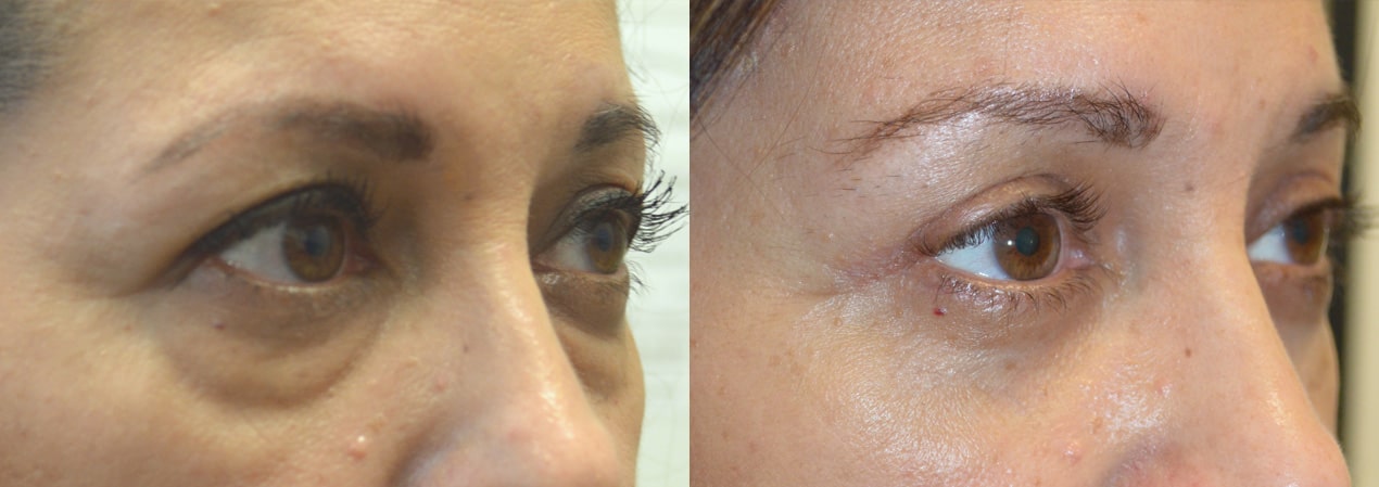 51 year old female, complained of looking tired and older due to saggy hooded upper eyelid and under eye bags and dark circles. She underwent upper blepharoplasty (eyelid lift), lower blepharoplasty (transconjunctival with fat repositioning and skin pinch removal) and lateral pretrichial brow lift (using temple hairline incision). Before and 3 months after cosmetic eyelid surgery photos are shown. Note natural rested eye appearance.