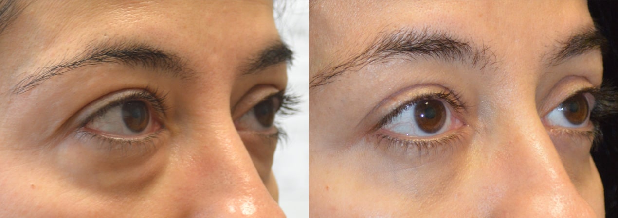 46 year old female, looking tired due to under eye fat bags and dark circles, underwent transconjunctival lower blepharoplasty with eye fat bags repositioning to surrounding hollow area plus skin pinch excision. Before and 2 months after cosmetic eyelid surgery photos are shown.