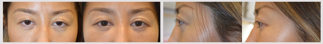 Young Asian woman underwent cosmetic orbital decompression, infraorbital rim silicone implant, lower eyelid retraction surgery with canthoplasty and droopy upper eyelid ptosis surgery. Note more almond shaped eyes in after photos.