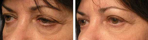 Before (left) and 3-months after (right) quad-blepharoplasty , canthoplasty, ptosis treatment.