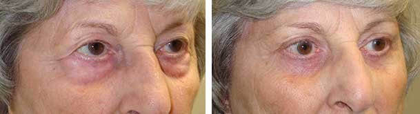 Before (left) and 3-months after (right) bilateral lower eyelid retraction surgery, with midface lift, canthoplasty.