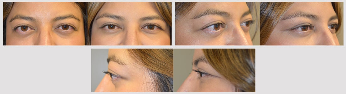 34 year old female, with bulging eyes from Graves disease, underwent combined orbital decompression surgery plus lower eyelid retraction surgery plus orbital rim (tear trough) implant placement. Before and 6 weeks after surgery results are shown. You can see her video testimonial on our website testimonial page and her surgical video on specified procedures.