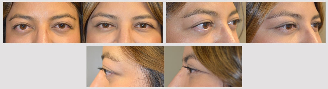 Treating Concurrent Under Eye Puffiness and Hollowness - Prasad Cosmetic  Surgery