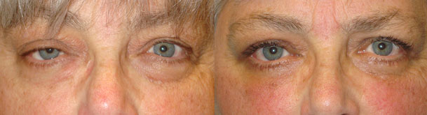 Before (left) and 3 months after (right) eyelid surgery including right upper eyelid ptosis surgery (eyelid lift through external approach), bilateral upper blepharoplasty (upper lid skin removal), and lower blepharoplasty (transconjunctival with fat repositioning and skin pinch).