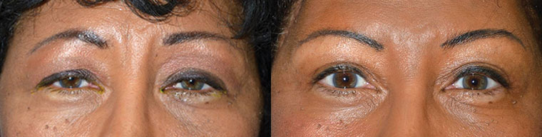 Before (left) and 3 months after (right) bilateral upper eyelid ptosis repair, upper blepharoplasty, and lateral pretrichial brow lift.