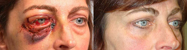 Before (left) and 3 months after (right) of multiple eyelid lacerations repair.