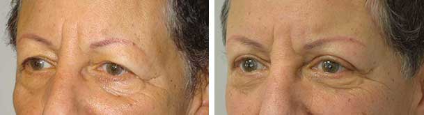 Before (left) and three months after (right) pretrichial brow lift and upper blepharoplasty