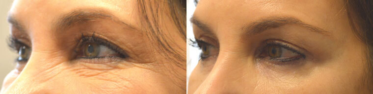 Before (left) and 2 months after (right) cosmetic eyelid surgery including upper blepharoplasty, lower blepharoplasty, and lateral brow lift.