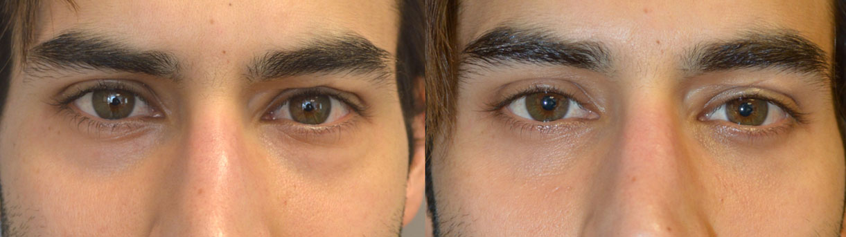 Before (left) and after (right) 27-year-old male actor who complained of looking tired on camera due to under eye bags and dark circles (hollowness). He underwent cosmetic lower blepharoplasty (transconjunctival with fat bags repositioning).