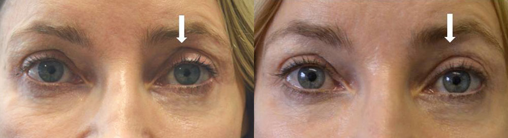 Before eye asymmetry due to left upper eyelid hollowness. After left upper eyelid filler injection with improved eye symmetry.