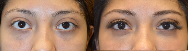 24 year old female, complained of bulging eyes and lower eyelid retraction with sclera show. She underwent NON-surgical upper eyelid filler and under eye filler injection. Before and 1 month after eyelid filler injection photos are shown.
